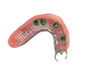 Denture with metal clasp and implant attachment