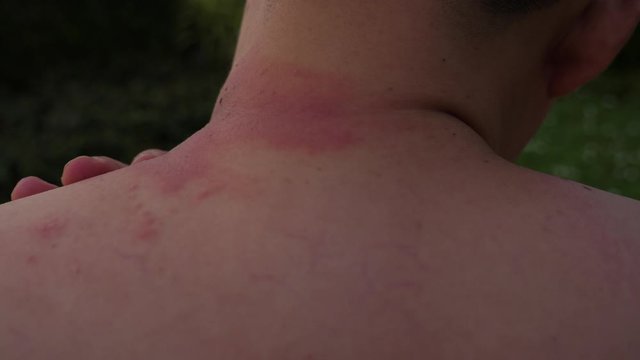 Handsome man get allergy of something that make his skin get swelled up, red rash, itchy. Asian guy get venoms of animals or Paederus dermatitis, Rove beetles bite him. He has a burning pain at skin