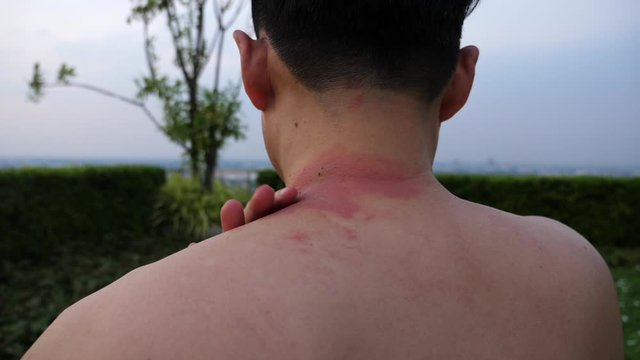Handsome man get allergy of something that make his skin get wound, swell up, red rash. Asian guy get venom of some animals or Paederus dermatitis, Rove beetles bite him. He has a burning pain at skin