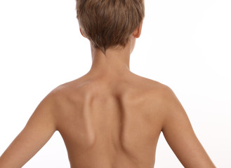Kid with Uneven Shoulder Blades: Scoliosis, Exercises, Treatments - obrazy, fototapety, plakaty