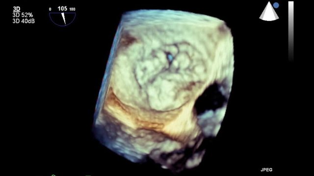 High quality transesophageal ultrasound video in 3D mode.