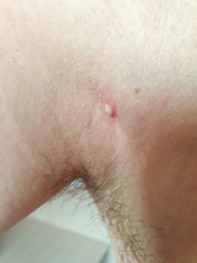 Fototapeta premium large abscess on the body of a man, acne and inflammation, skin diseases