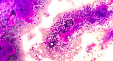 Fine needle aspiration (FNA) cytology of a benign mixed tumor of the salivary gland (pleomorphic...
