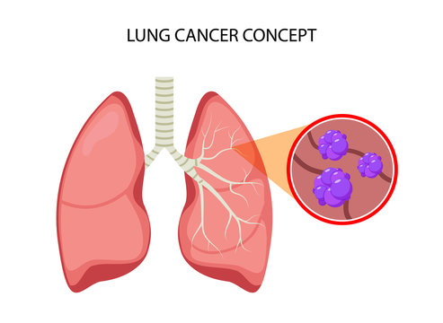 Lung cancer vector concept repiratory disease. Cartoon human lung cancer icon