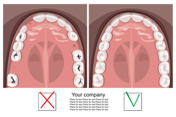 A teeth on the jaw looking over before and after the dentist or orthodontist with place for text, a flat vector stock illustration with adult caries, molars and gums