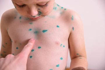 Young toddler with chickenpox. Sick child with chickenpox. Varicella virus or Chickenpox bubble rash on child body and face.  Portrait of little boy with pox.