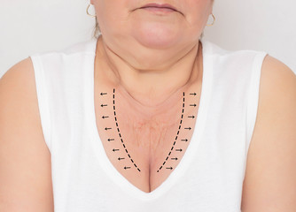 Woman with problem skin in the decollete area on a white background. The concept of plastic surgery...