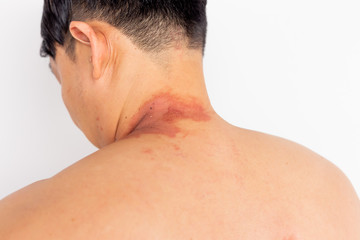 Handsome man get allergy of something that make his skin get wound, swell up, red rash. Asian guy...