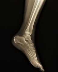 normal radiography of the ankle joint in the lateral projection