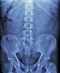 x-ray of the abdominal cavity and pelvis in direct projection, medical research,urography