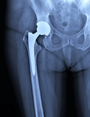 x-ray of hip replacement,implantation, orthopedics