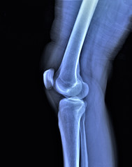 Obraz premium x ray of the knee joint , medical diagnostics, traumatology and orthopedics