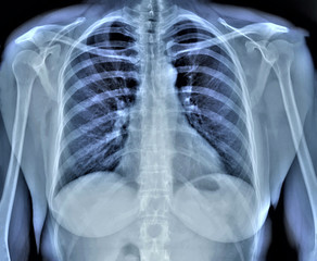 normal radiography of chest organs in direct projection, traumatology and orthopedics, pulmonology