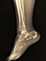 normal radiography of the ankle joint in the lateral projection