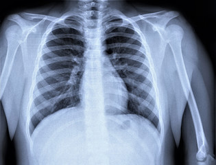 normal radiography of chest organs in direct projection, traumatology and orthopedics, pulmonology