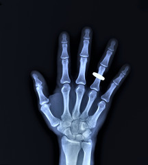 x-ray of the right hand with a wedding ring