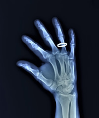 x-ray of the right hand with a wedding ring
