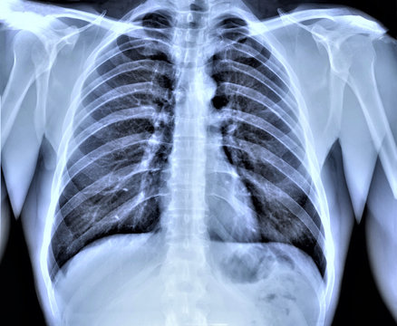 normal radiography of chest organs in direct projection, traumatology and orthopedics, pulmonology