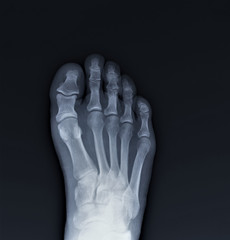 normal radiography of the foot, medical diagnostics, Traumatology and orthopedics, rheumatology