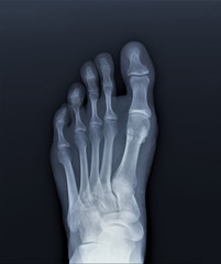normal radiography of the foot, medical diagnostics, Traumatology and orthopedics, rheumatology