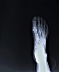normal radiography of the foot, medical diagnostics, Traumatology and orthopedics, rheumatology