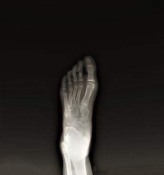 normal radiography of the foot, medical diagnostics, Traumatology and orthopedics, rheumatology
