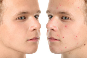 Teenage boy without and with acne on white background