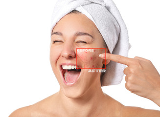Happy young woman before and after acne treatment on white background