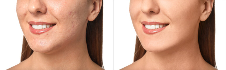 Young woman with acne problem on white background, closeup