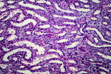 Chronic nephritis, light micrograph, photo under microscope