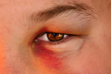 Eye injury, male with black eye isolated on white. man after accident or fight .