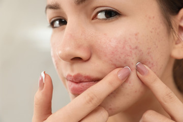 Teen girl with acne problem squeezing pimple on her face, closeup