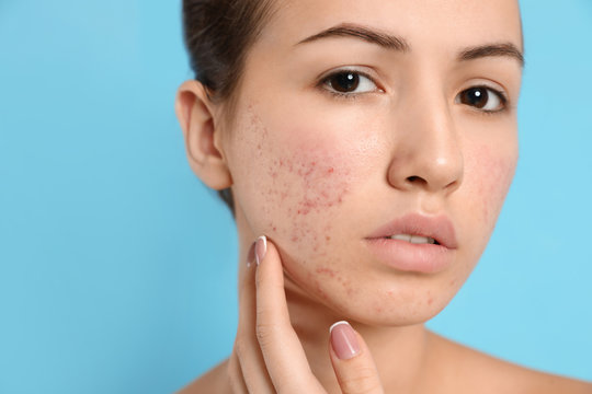 Teen girl with acne problem on light blue background