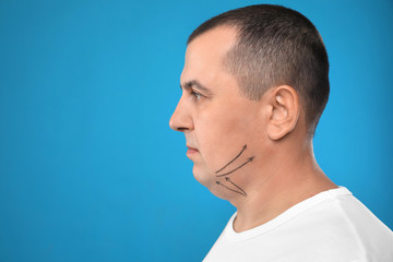 Fototapeta premium Mature man with marks on face against blue background, space for text. Double chin removal