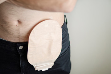 Front view on colostomy bag attached to man patient, medical theme. Selective focus on skin color...