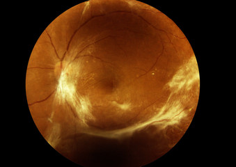 Retinal image in diabetic patients There are many white fibers .
