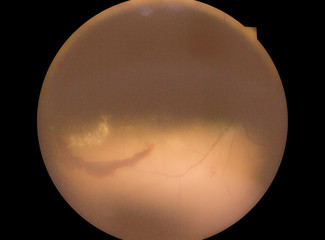 Medical photo retina of diabetic - exudate