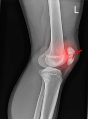 Knee joint x-ray fracture kneecap.