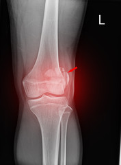 Knee joint x-ray fracture patella