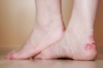 Woman's feet with blister close up. Injured foot from high heels.  - obrazy, fototapety, plakaty