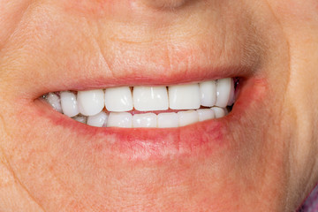 Plaque of the patient, stone. Dentistry treatment of dental plaque, professional oral hygiene. The...