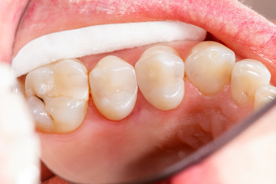 two chewing side teeth of the upper jaw after treatment of caries. Restoration of the chewing surface with a photopolymer filling material using the Rubber Dam system