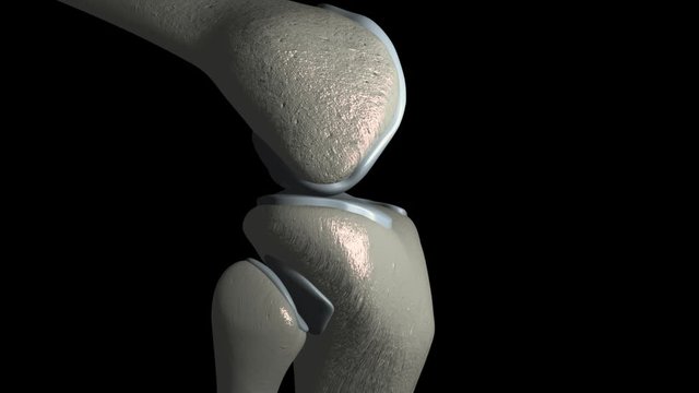 Knee Osteoarthritis With Osteophytes