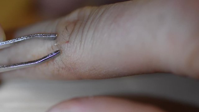 Macro shot of removing a wooden thorn or splinter from a finger with tweezers.