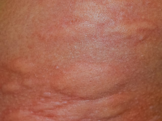 Allergy skin back and sides. Allergic reactions on the skin in the form of swelling and redness