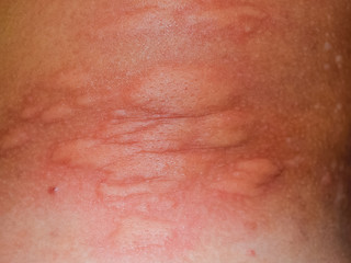 Allergy skin back and sides. Allergic reactions on the skin in the form of swelling and redness