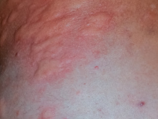 Fototapeta premium Allergy skin back and sides. Allergic reactions on the skin in the form of swelling and redness