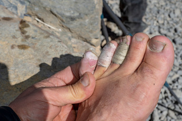 injured fingers while camping in the mountains of the Himalayas. Nepal
