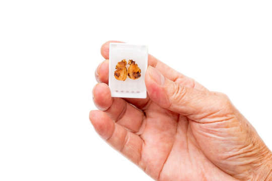 Man Holding Paraffin Embedded Tissue Blocks of Cancer on iSolated White Background