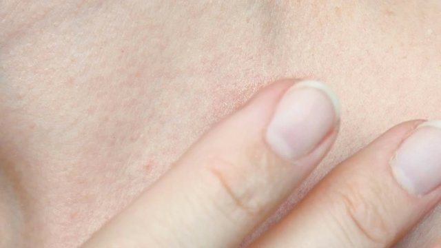 skin rash treatment on woman neck. Shingles, Disease, Herpes zoster, varicella-z, lichenoid dermatitis, pityriasis